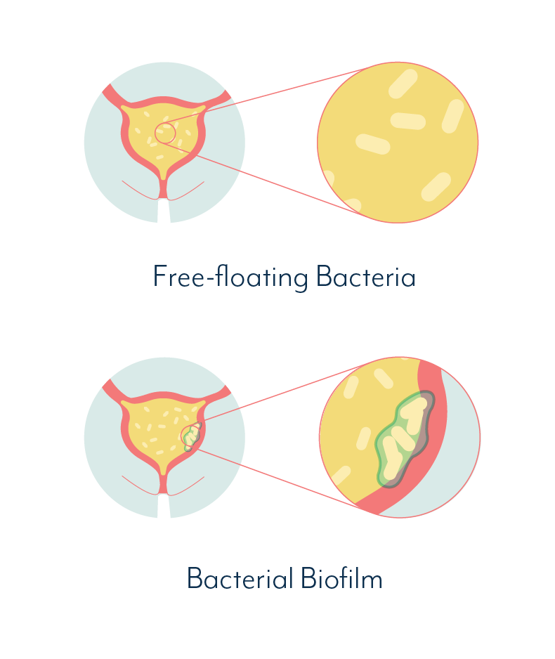 Chronic Urinary Tract Infection - Biofilms cause chronic bladder infection