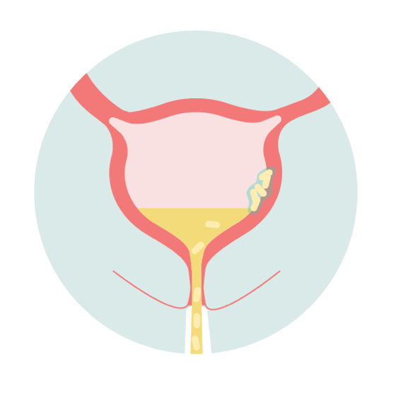 Chronic Urinary Tract Infection - UTI Pathway Step 4