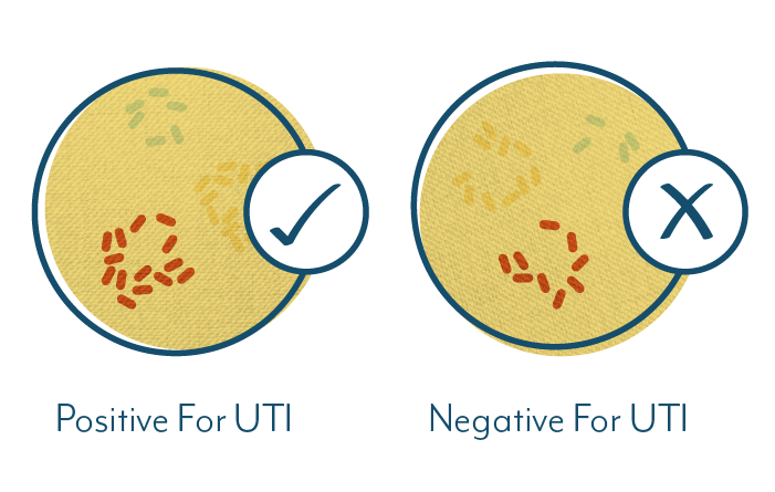 Why Your UTI Test May Be Negative Even When You Have Symptoms   UTI Test Positive Vs Negative Culture 