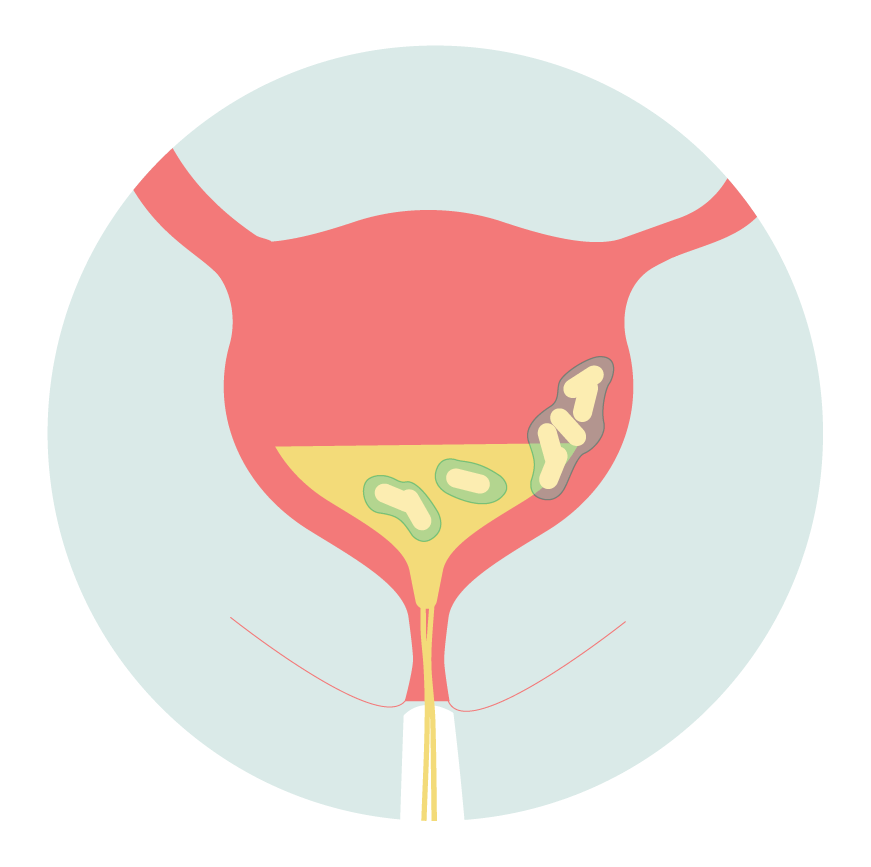 Testing for biofilms in urine