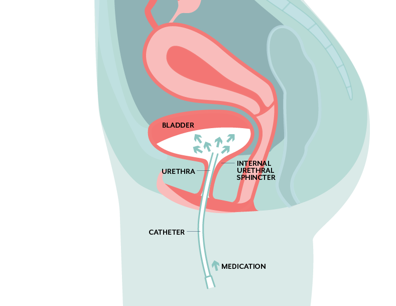 Antibiotic bladder instill female anatomy