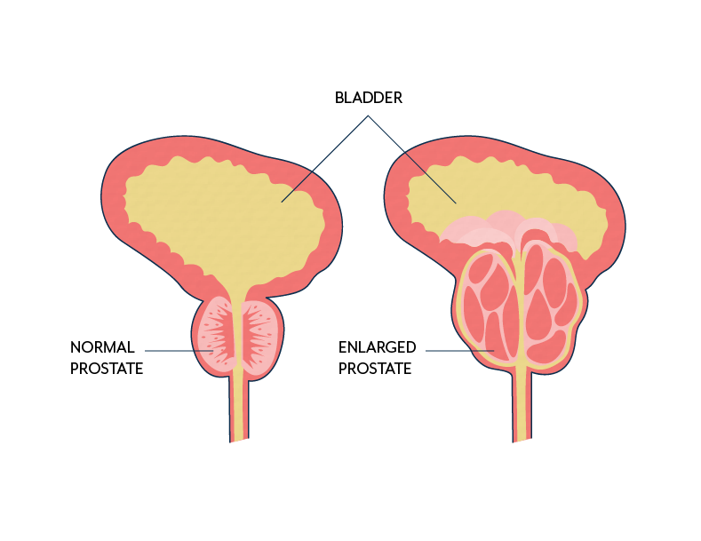 What Causes Bladder Leakage? Types & Causes of Urinary