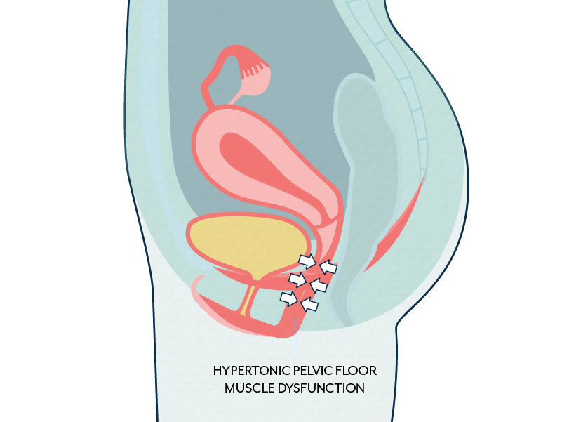 What Is High Tone Pelvic Floor Dysfunction