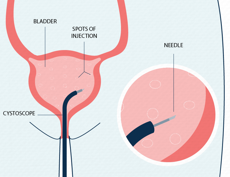 Can Urinary Incontinence Cause UTIs? Short answer - Yes!