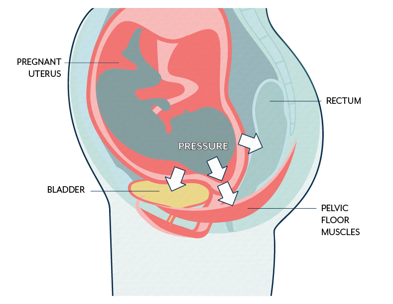 Leaking urine during pregnancy