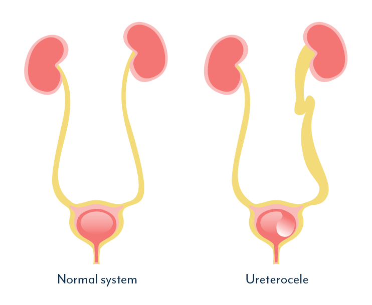 Ureterocele, lower urinary tract symptoms and recurrent UTI