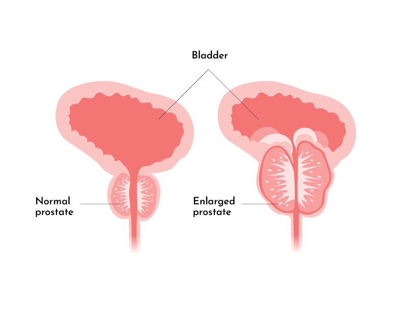 Recurrent UTI In Men Prevalence And Causes