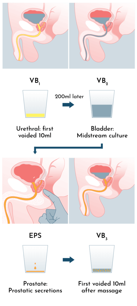 Bladder Infection Signs: How To Spot Them