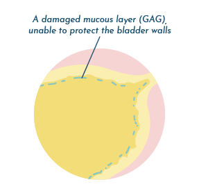 Damaged GAG layer in bladder